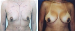 Breast Augmentation Patient Before & After Photo 1