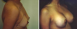 Breast Augmentation Patient Before & After Photo 1