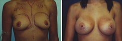 Breast Augmentation Patient Before & After Photo 1