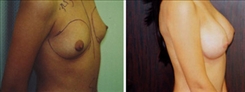 Breast Augmentation Patient Before & After Photo 1