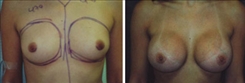 Breast Augmentation Patient Before & After Photo 1