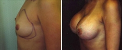 Breast Augmentation Patient Before & After Photo 1