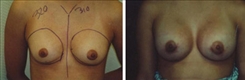 Breast Augmentation Patient Before & After Photo 1