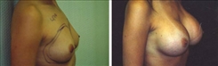 Breast Augmentation Patient Before & After Photo 1