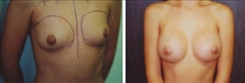 Breast Augmentation Patient Before & After Photo 1