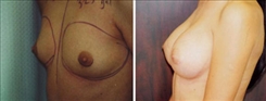 Breast Augmentation Patient Before & After Photo 1