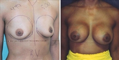 Breast Augmentation Patient Before & After Photo 1