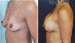 Breast Augmentation Patient Before & After Photo 1