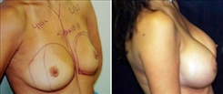 Breast Augmentation Patient Before & After Photo 1