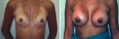 Breast Augmentation Patient Before & After Photo 1