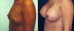 Breast Augmentation Patient Before & After Photo 1