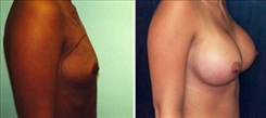 Breast Augmentation Patient Before & After Photo 1