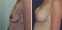 Breast Augmentation Patient Before & After Photo 1