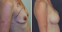 Breast Augmentation Patient Before & After Photo 1