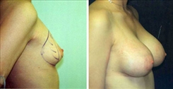 Breast Augmentation Patient Before & After Photo 1