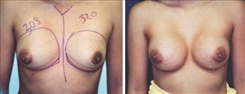 Breast Augmentation Patient Before & After Photo 1