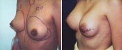 Breast Augmentation Patient Before & After Photo 1