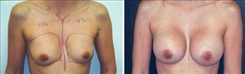 Breast Augmentation Patient Before & After Photo 1