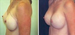 Breast Augmentation Patient Before & After Photo 1