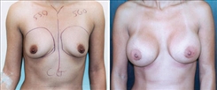 Breast Augmentation Patient Before & After Photo 1