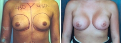 Breast Augmentation Patient Before & After Photo 1