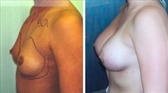 Breast Augmentation Patient Before & After Photo 1