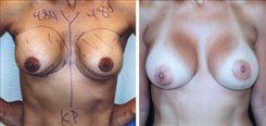 Breast Augmentation Patient Before & After Photo 1