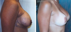 Breast Augmentation Patient Before & After Photo 1