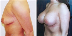 Breast Augmentation Patient Before & After Photo 1