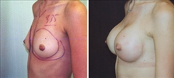 Breast Augmentation Patient Before & After Photo 1