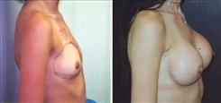 Breast Augmentation Patient Before & After Photo 1