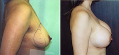 Breast Augmentation Patient Before & After Photo 1