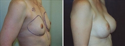 Breast Augmentation Patient Before & After Photo 1