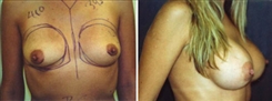 Breast Augmentation Patient Before & After Photo 1