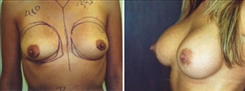 Breast Augmentation Patient Before & After Photo 1