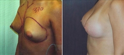 Breast Augmentation Patient Before & After Photo 1