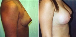 Breast Augmentation Patient Before & After Photo 1