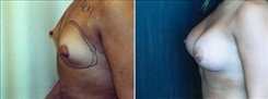 Breast Augmentation Patient Before & After Photo 1