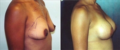 Breast Augmentation Patient Before & After Photo 1