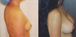 Breast Augmentation Patient Before & After Photo 1