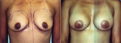 Breast Augmentation Patient Before & After Photo 1