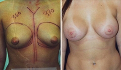 Breast Augmentation Patient Before & After Photo 1