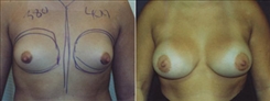 Breast Augmentation Patient Before & After Photo 1