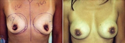 Breast Augmentation Patient Before & After Photo 1