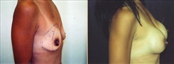 Breast Augmentation Patient Before & After Photo 1