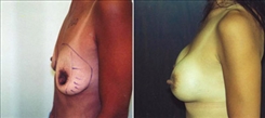 Breast Augmentation Patient Before & After Photo 1