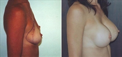 Breast Augmentation Patient Before & After Photo 1