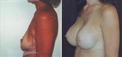 Breast Augmentation Patient Before & After Photo 1