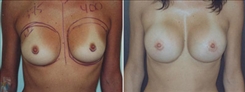 Breast Augmentation Patient Before & After Photo 1