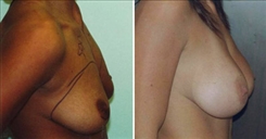 Breast Augmentation Patient Before & After Photo 1